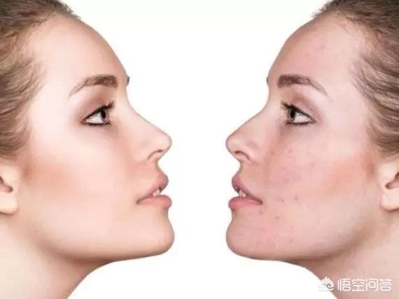 什么样的皮肤适合刷酸，刷酸到底是换脸还是烂脸？