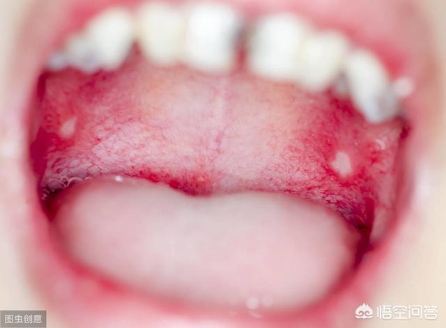 口腔疾病有哪些，口腔溃疡经久不愈，有可能是口腔癌吗？
