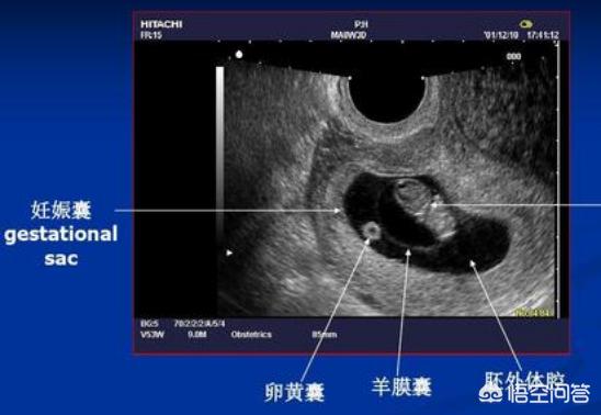 头条问答 怀孕四周可以看到孕囊吗 应该注意哪些事项 25个回答
