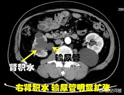 尿结石的治疗方法:1.6厘米的尿路结石怎么处理？