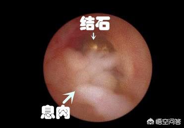 尿结石的治疗方法:1.6厘米的尿路结石怎么处理？