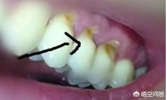 幼儿牙龈萎缩怎么办:牙龈萎缩的牙根都快露出来了，刷牙时还酸痛，该如何挽救？
