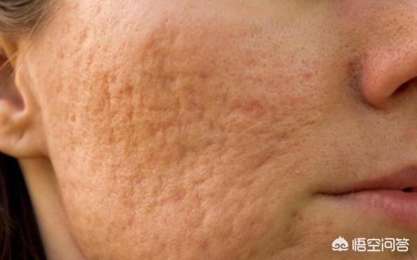 我的毛孔比以前还要粗大了?(6个回答)