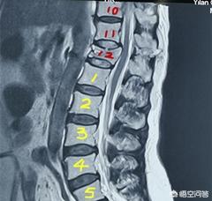 骨折治疗:骨折治疗的三大原则 腰椎一节压迫性骨折手术治疗好还是保守治疗好？