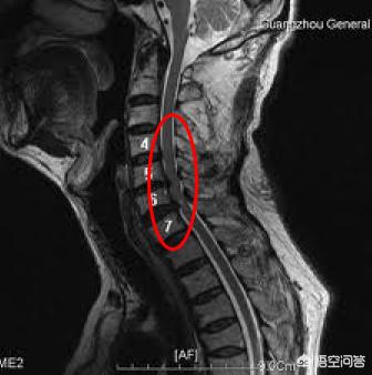 水牛背:早晨醒来双手发胀，握不拢，几分钟后就正常了，是怎么回事