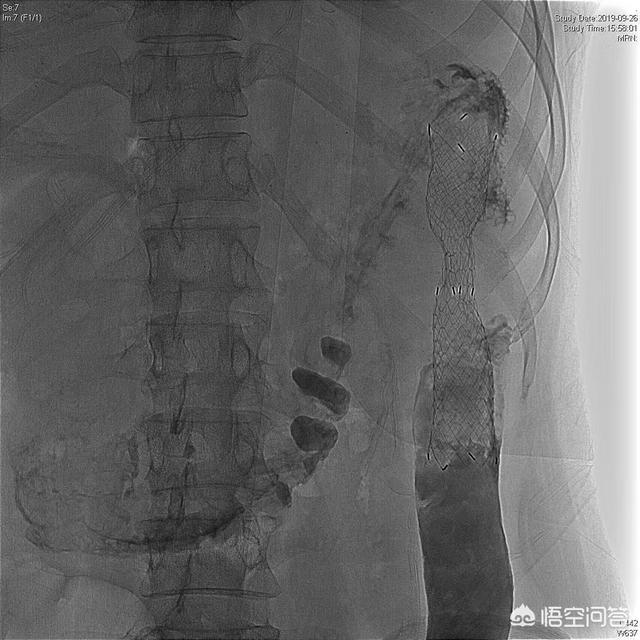 癌症晚期肠梗塞不治疗会怎样:你身边不吃不喝的人癌症病人活了多久？