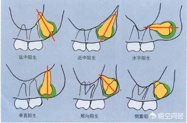 牙齿远中近中示意图图片