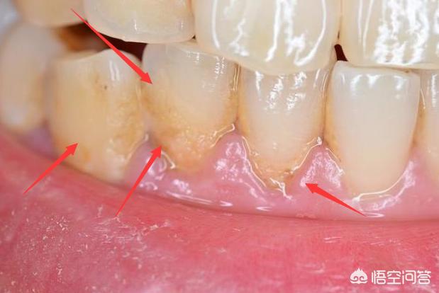 牙结石会使唾液臭吗:牙结石会导致唾液臭吗 牙缝里面软软发臭的黄泥，是什么，扣下来闻还很臭？