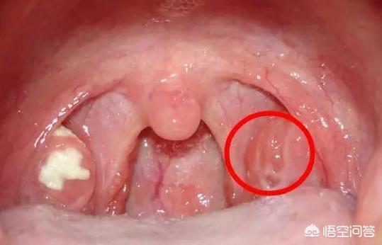 头条问答 四周岁孩子一发烧 就是化脓性扁桃体发炎 经常性这样 怎样调理体质 32个回答