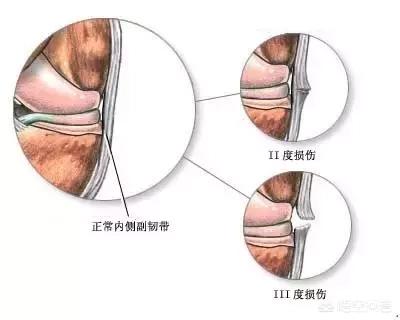 屁股外侧韧带拉伤怎么办:侧副韧带损伤会造成哪些问题？怎么治疗？