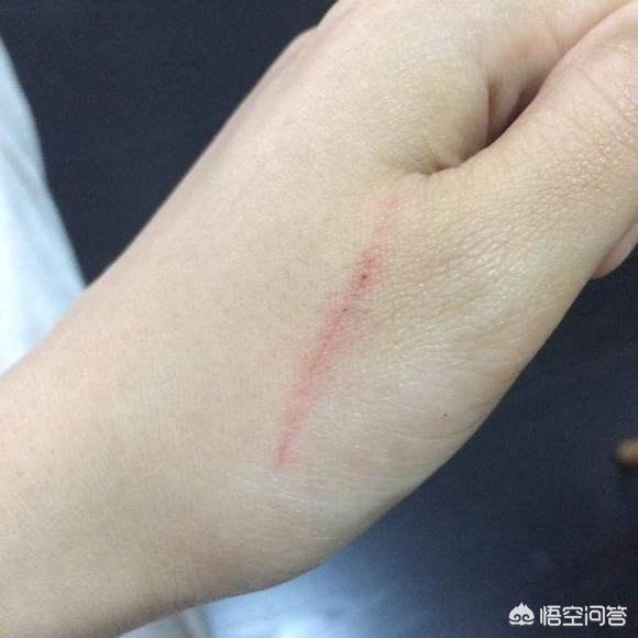 被猫抓了一下轻微破皮要打针吗:被自家猫抓了手，有轻微出血，这种情况下要不要打疫苗？