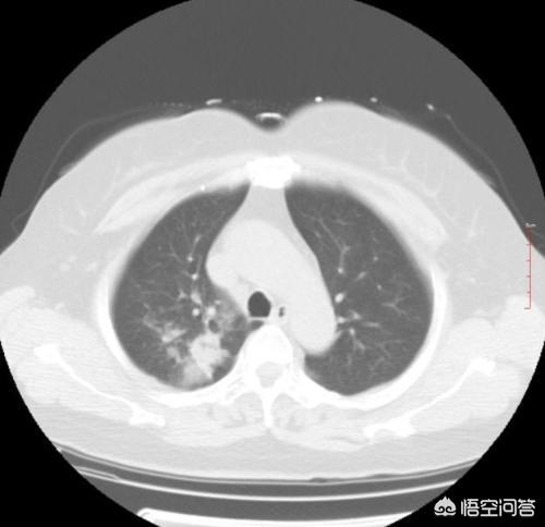 外周血是什么意思,外周血验肺癌到底靠谱吗？