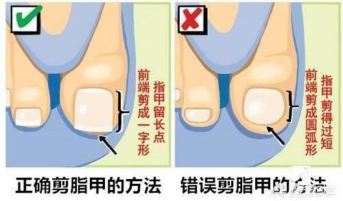 脚上大拇指的指甲长到肉里怎么办:脚趾甲盖长到肉里了是怎么回事？以前不是！最近几年是这样？