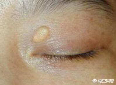 7莱姆病症状太容易被忽视:血脂越来越高，皮肤会出现哪些症状？