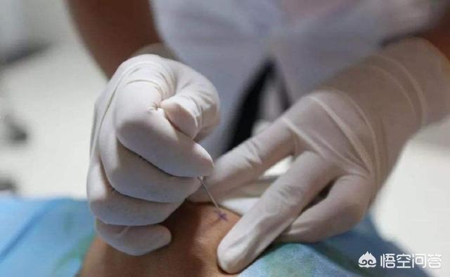 手部增生性关节炎怎么治:什么是关节炎？如何治疗关节炎？ 手关节增生性关节炎怎么治