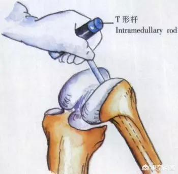 膑骨术练股四头肌:人工膝关节置换手术步骤？