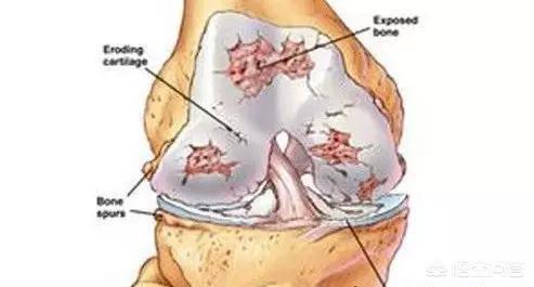 关节炎怎么治疗:创伤性关节炎有哪些症状？该如何治疗？