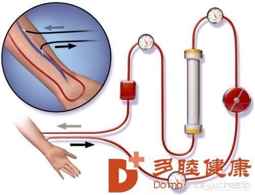 素力高怎么样:血液净化体外循环血液净化（DFPP）是什么？