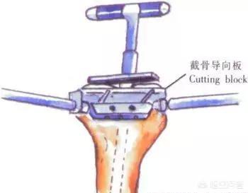 膑骨术练股四头肌:人工膝关节置换手术步骤？