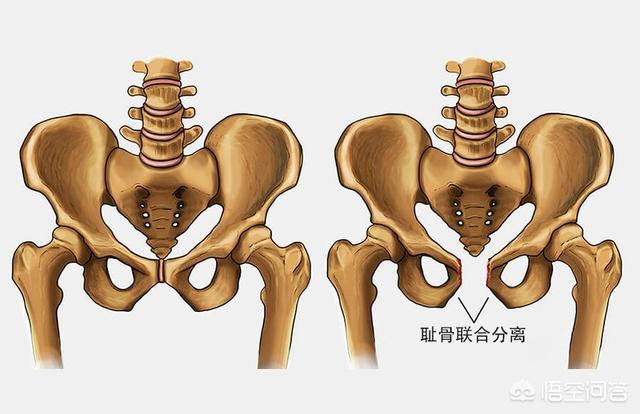 耻骨图片耻骨位置图孕妇