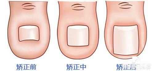 脚上大拇指的指甲长到肉里怎么办:脚趾甲盖长到肉里了是怎么回事？以前不是！最近几年是这样？