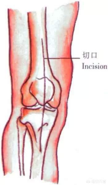 膑骨术练股四头肌:人工膝关节置换手术步骤？