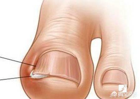 脚上大拇指的指甲长到肉里怎么办:脚趾甲盖长到肉里了是怎么回事？以前不是！最近几年是这样？