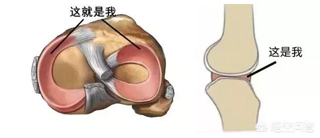 膝关节半月板损伤:膝关节半月板损伤怎么治疗比较好 膝关节半月板是什么？损伤后怎么办？