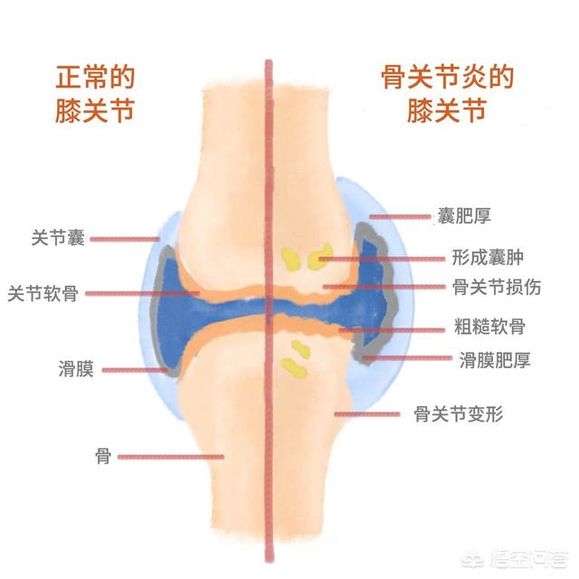 导致膝关节炎原因有哪些，膝关节酸痛是什么原因引起的膝关节疼痛原因主要是什么