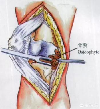 膑骨术练股四头肌:人工膝关节置换手术步骤？