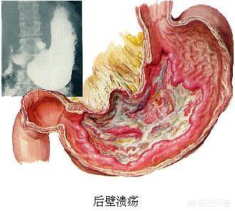 头条问答 - 请问十二指肠球部溃疡,吃什么药能有效根治?(7个回答)
