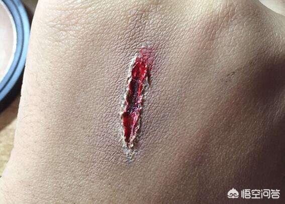 头条问答 - 脚踩钉子了,一定要打破伤风针吗?(8个回答)