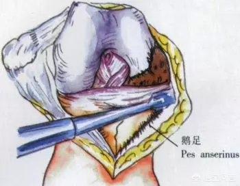 膑骨术练股四头肌:人工膝关节置换手术步骤？