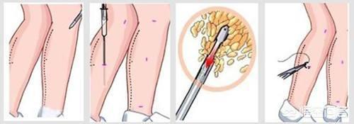 肌肉腿可以抽脂吗:做大腿吸脂的效果怎么样？