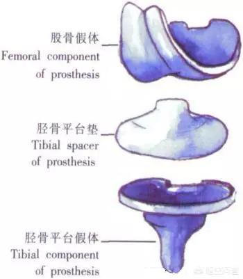 膑骨术练股四头肌:人工膝关节置换手术步骤？