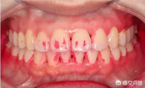 牙周炎的治疗(牙周炎的治疗方法有哪些)