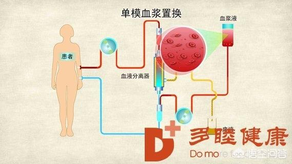 素力高怎么样:血液净化体外循环血液净化（DFPP）是什么？