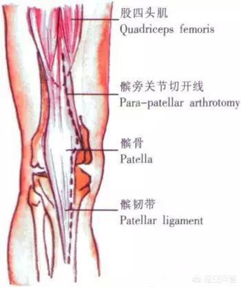 膑骨术练股四头肌:人工膝关节置换手术步骤？