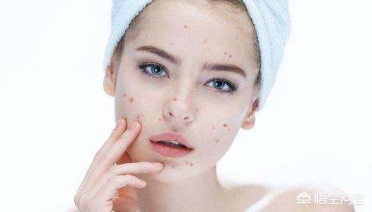 如何除痘坑(如何除痘坑的方法)