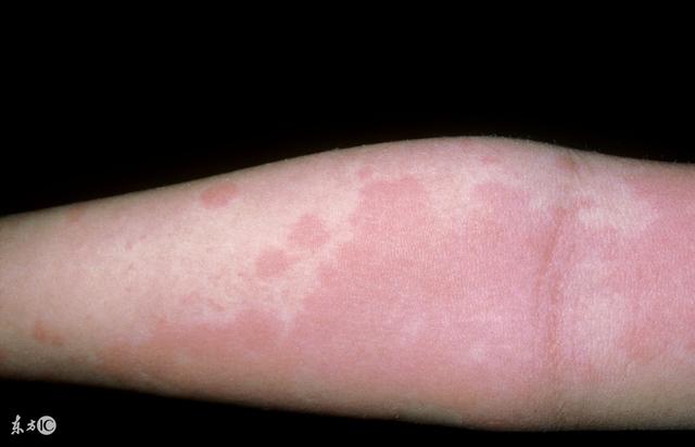 新鲜芝麻杆可以用来治疗荨麻疹是真的吗？