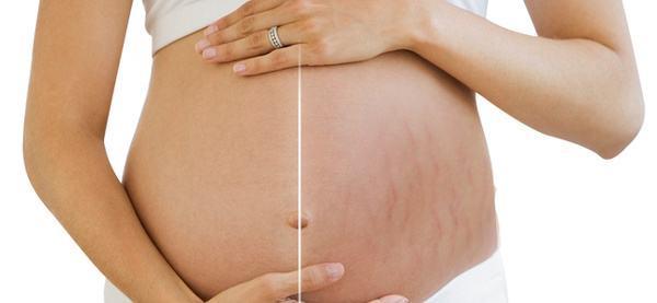 如何消除妊娠纹:如何去妊娠纹最有效的方法