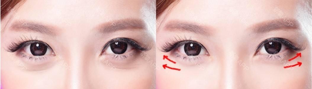 眼袋纹(眼袋纹图片)