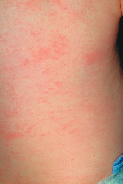 如何正确区分湿疹和幼儿急疹？