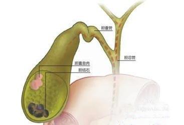 张一山胆囊长有息肉,这个病危险吗？会危及生命吗？