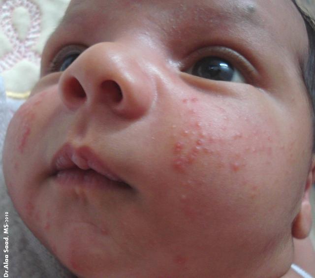 如何正确区分湿疹和幼儿急疹？