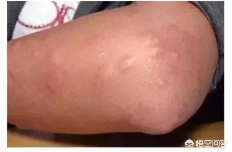 吸血虫子:蚊子能吸血，还有什么吸血？