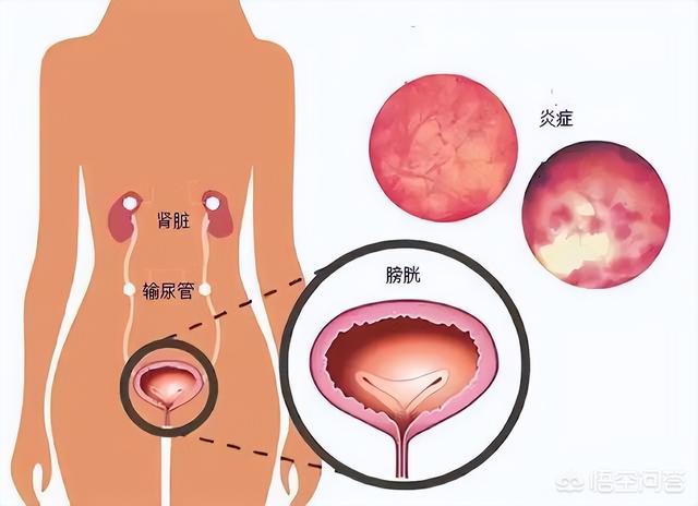 大姨妈刚走尿血是什么原因引起的:姨妈刚走同房完又出血了是怎么回事？