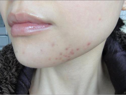 头条问答 - 下巴位置长过痘之后留下了一片的痘印怎么办?(3个回答)