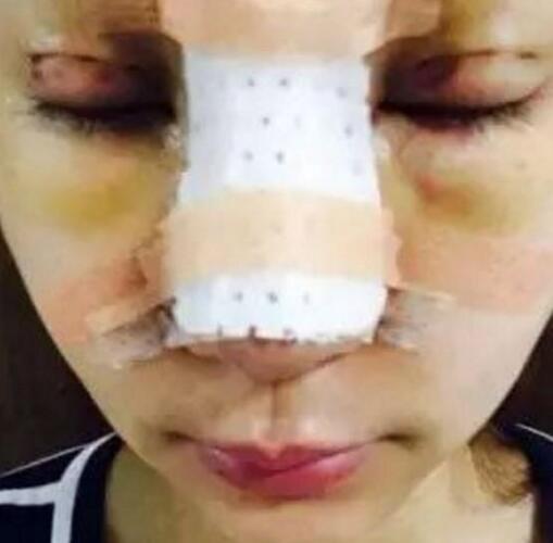 金晨整容呀对比:又有一女孩花百万整成迪丽热巴，大家怎么看待整容？