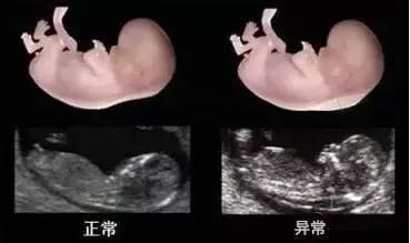 nt是啥意思,12周做NT是什么意思呀？